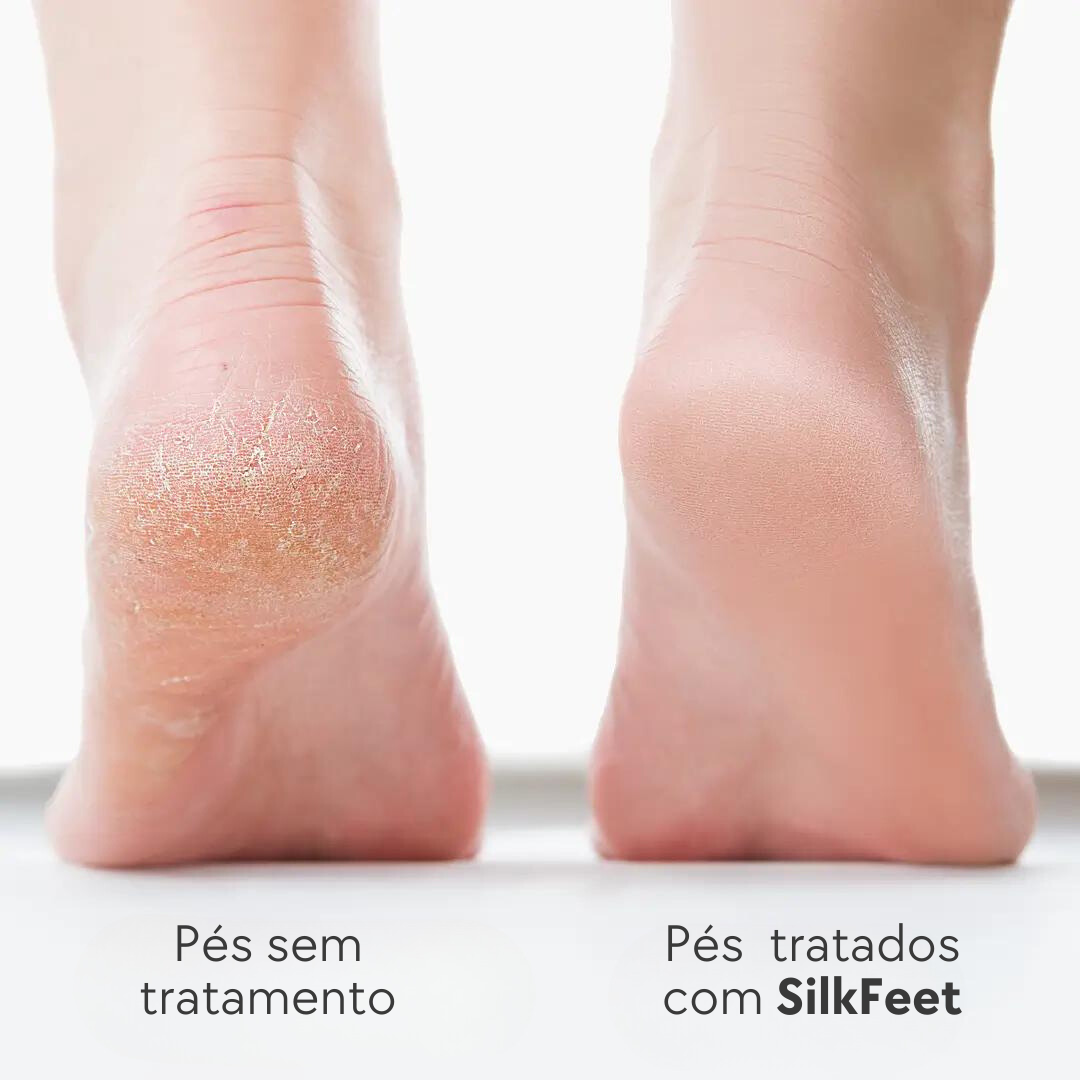 SilkFeet - Tratamento para os Pés